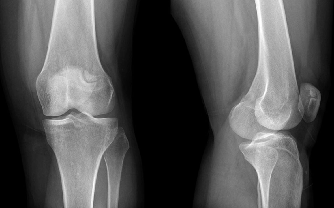 De artrose van de knie op de X -Ray vóór het gebruik van Hondroine
