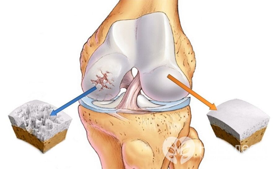 Arthrose van de knie