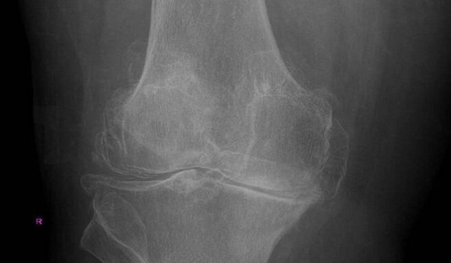 Diagnose van artrose