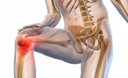 Arthrose van het kniegewricht