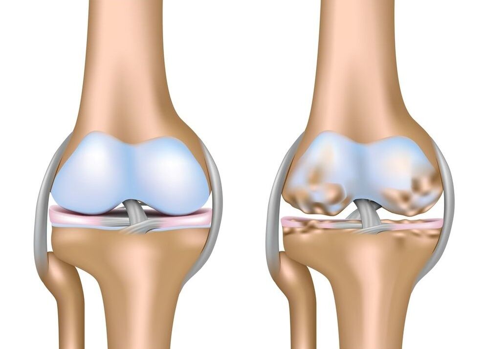 Arthrose van het kniegewricht