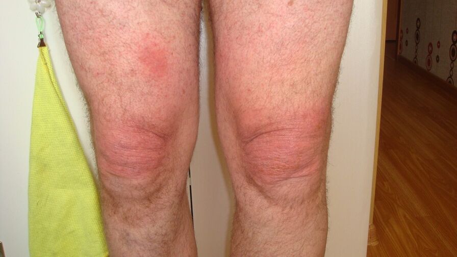 artrose van de kniegewrichten